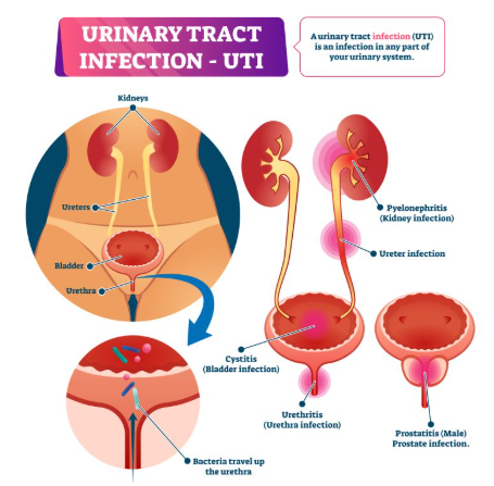 Urinary Tract Infections